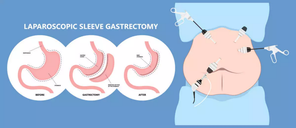 Sleeve Gastrectomy